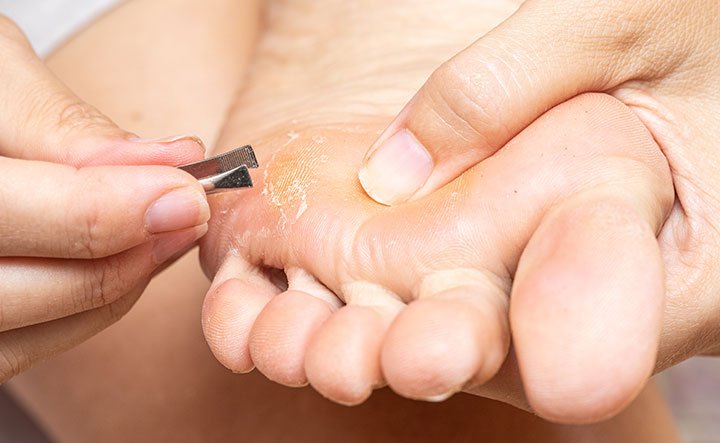 Understanding and Treating Corns: Expert Podiatry Care in Atherton